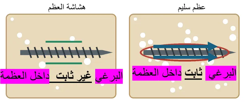مقارنة تثبيت البرغي في العظم السليم والهش