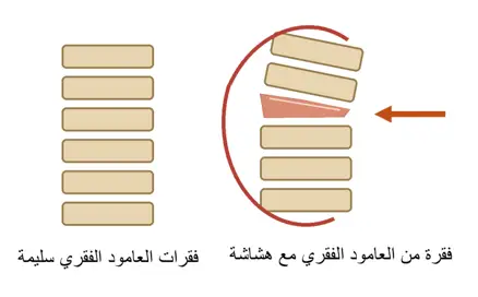 انضغاط فقري بسبب هشاشة العظام